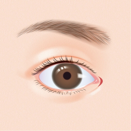 目の下の脂肪取り（経結膜脱脂法）