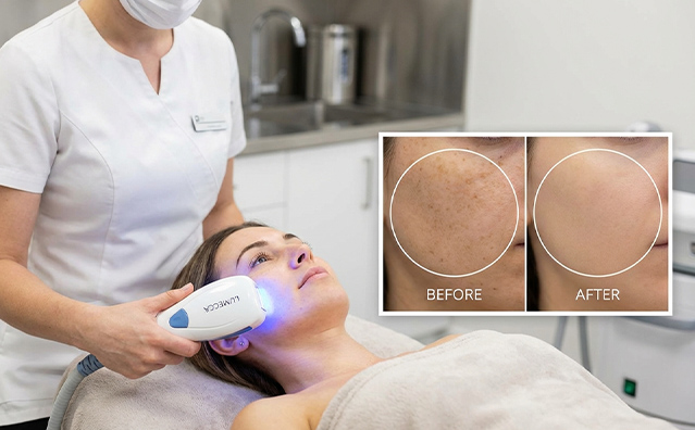 ウルトラフォーマーMPT