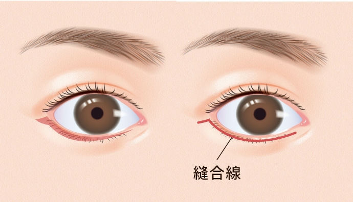 下眼瞼除皺術の施術方法