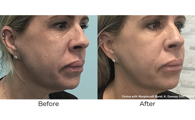 モフィウス8バーストBA画像