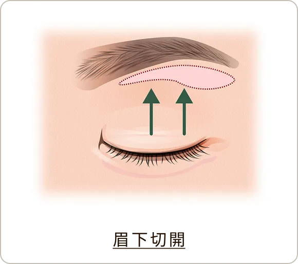 眉下切開