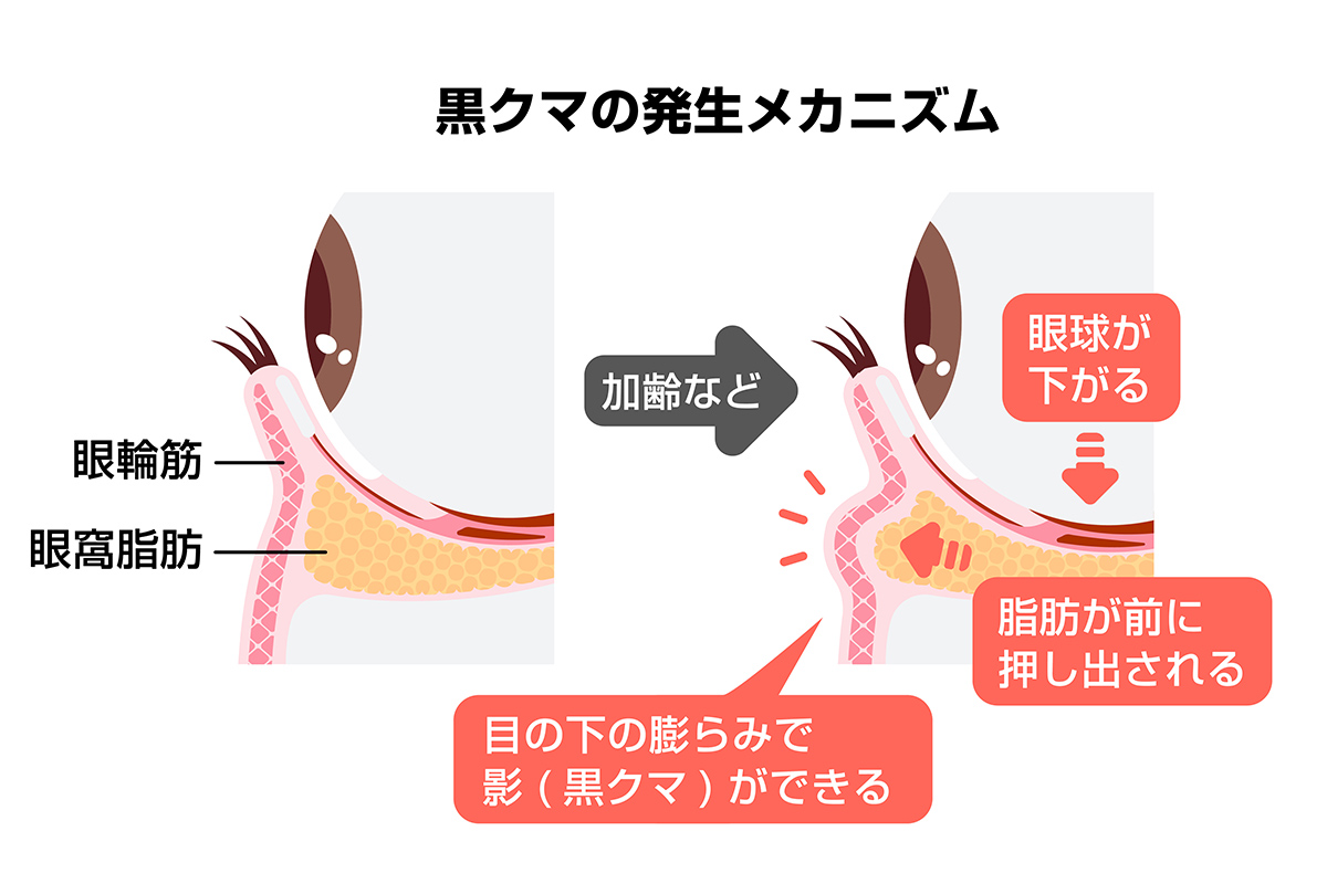 1-1. クマの凹み、原因は「生まれつき」か「施術後」