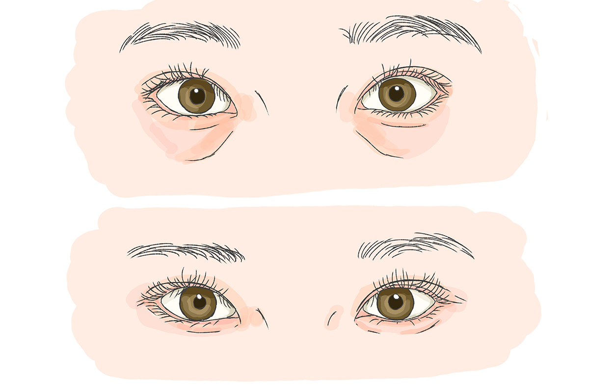 第5章 クマ取りで涙袋は出る？