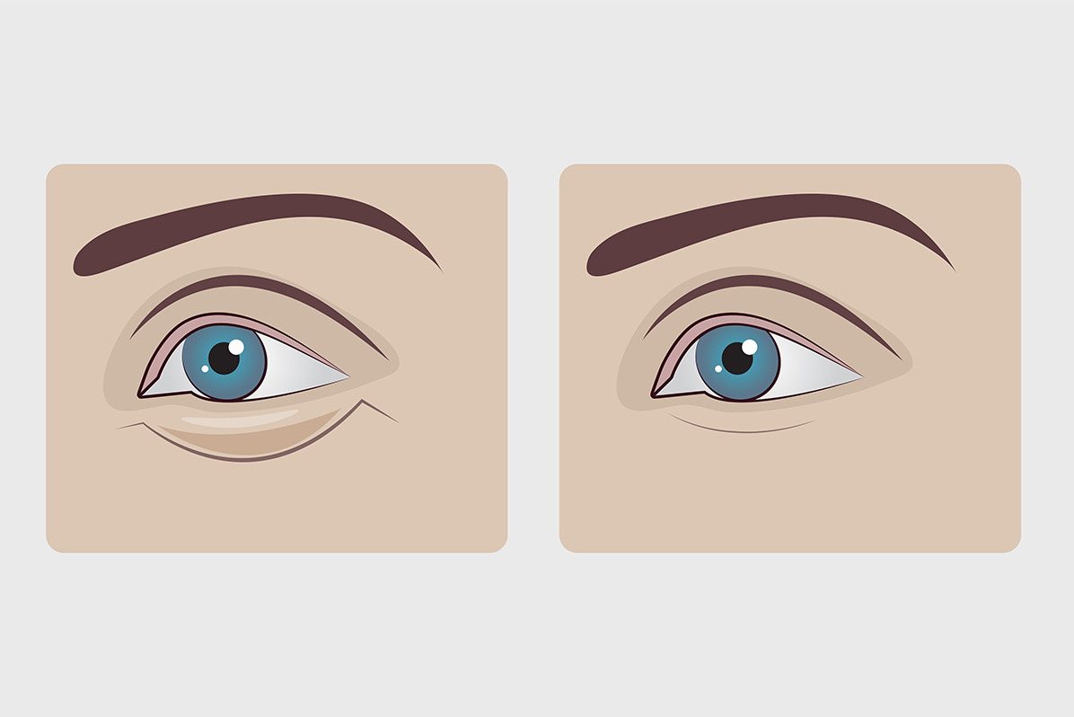  第4章 施術別のダウンタイムの期間と症状の違い