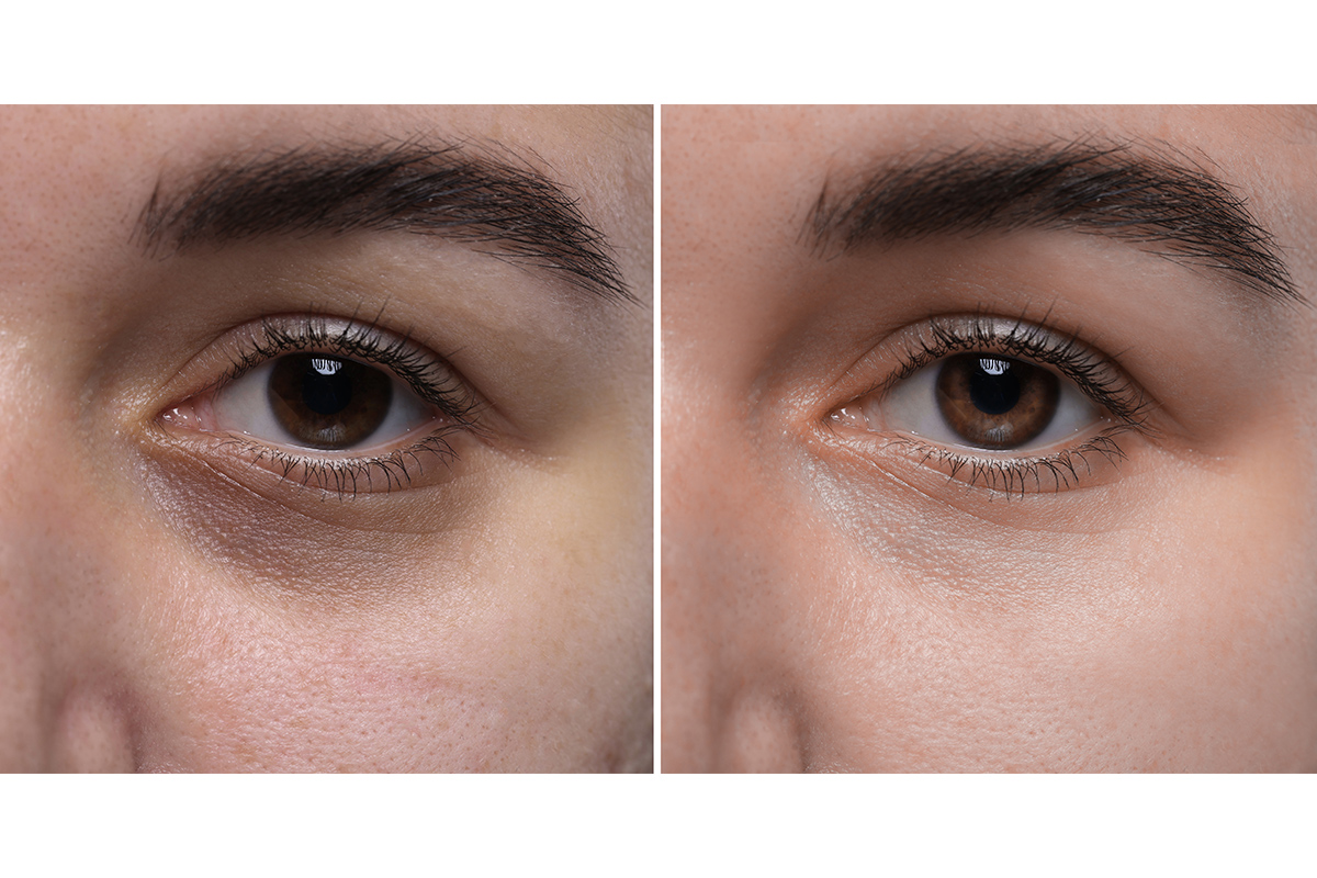 4-1. 【黒クマ】手術でたるみの影を除去