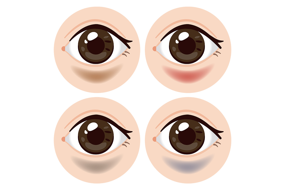  第2章 ダウンタイム中の腫れと内出血はいつまで？