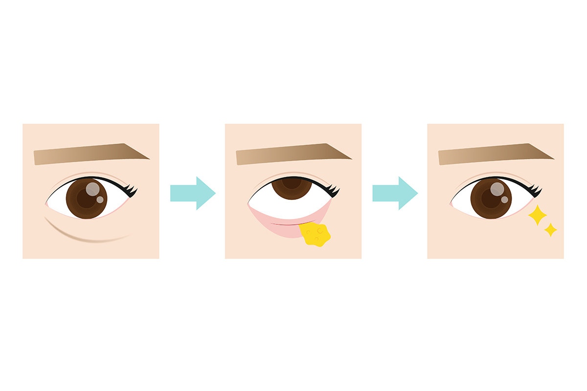 3-2. 涙袋を残してクマだけを改善することは可能？