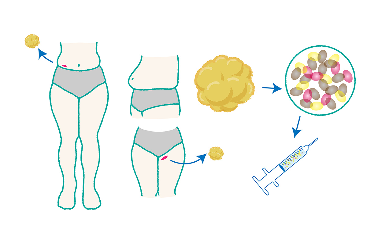2-3. 修正治療②：脂肪注入