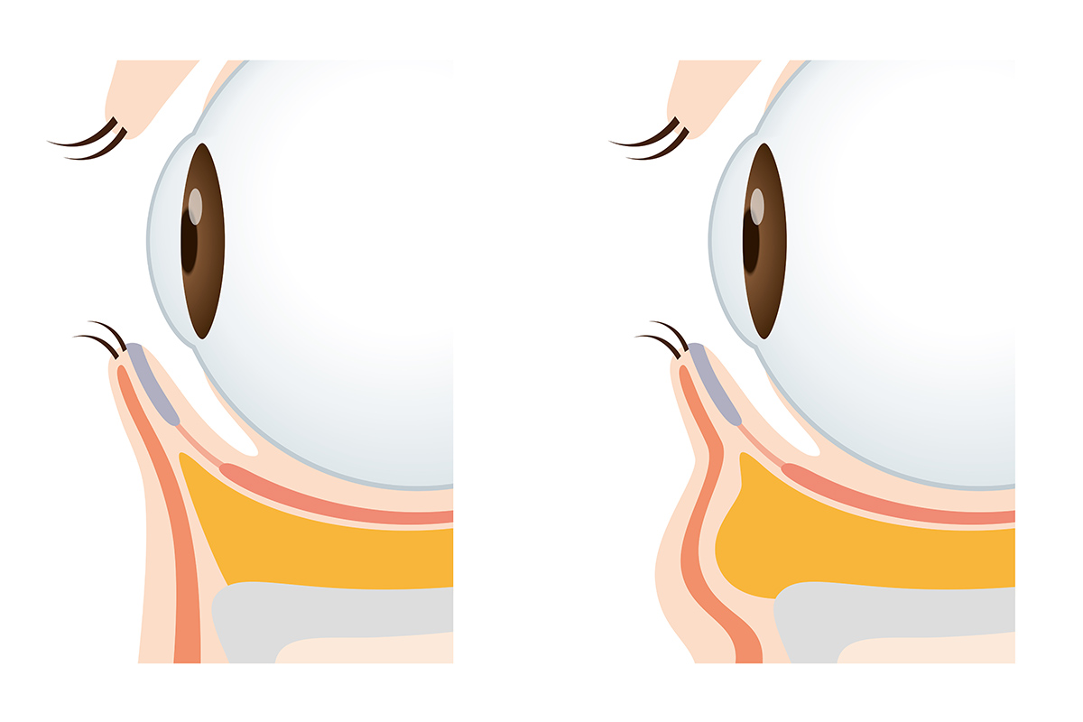 第4章 セルフケアでは限界？黒クマを解消する美容医療