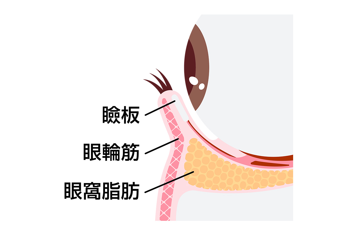 第2章 クマ取り施術の方法によるダウンタイムの違い