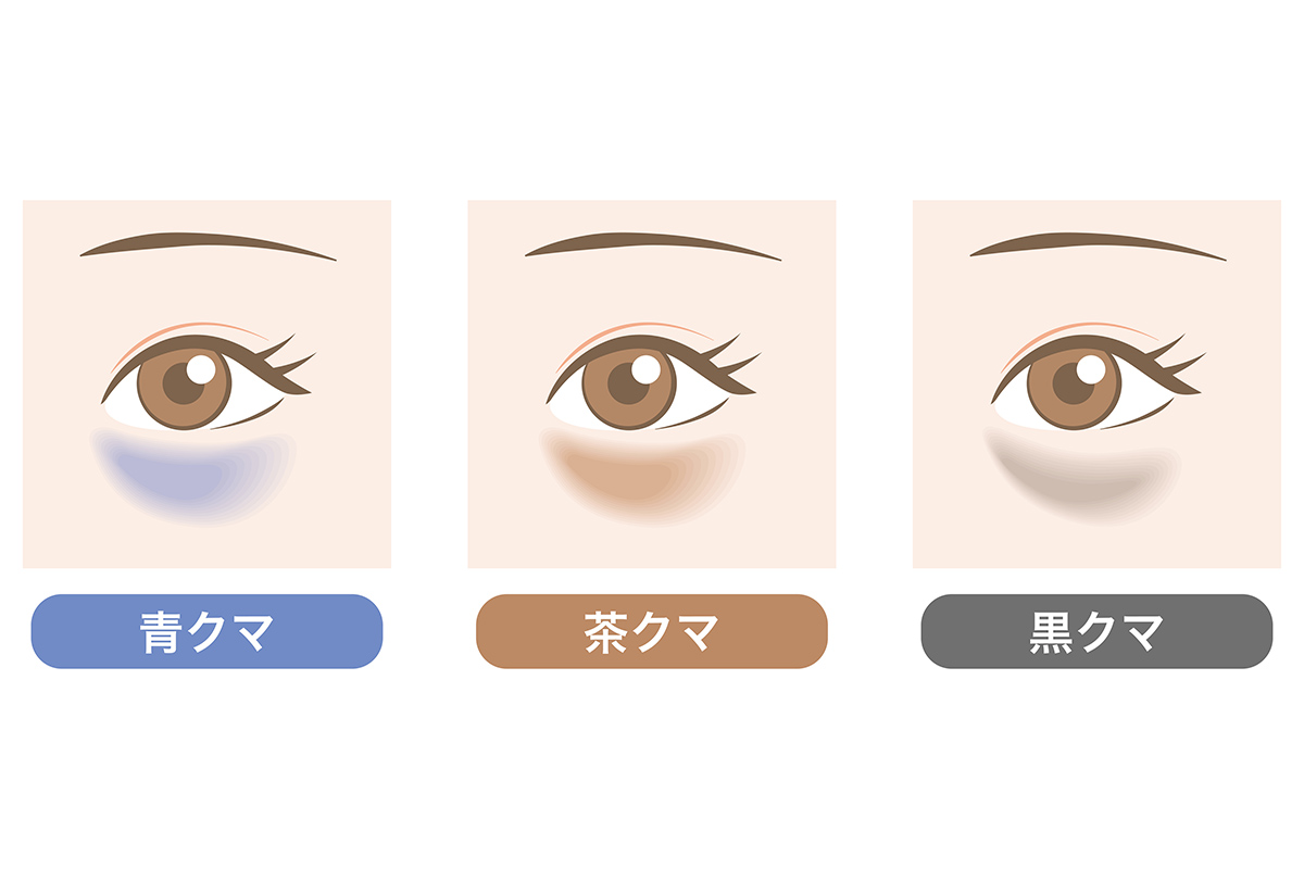 1-1. 目の周りの色素沈着=「茶クマ」