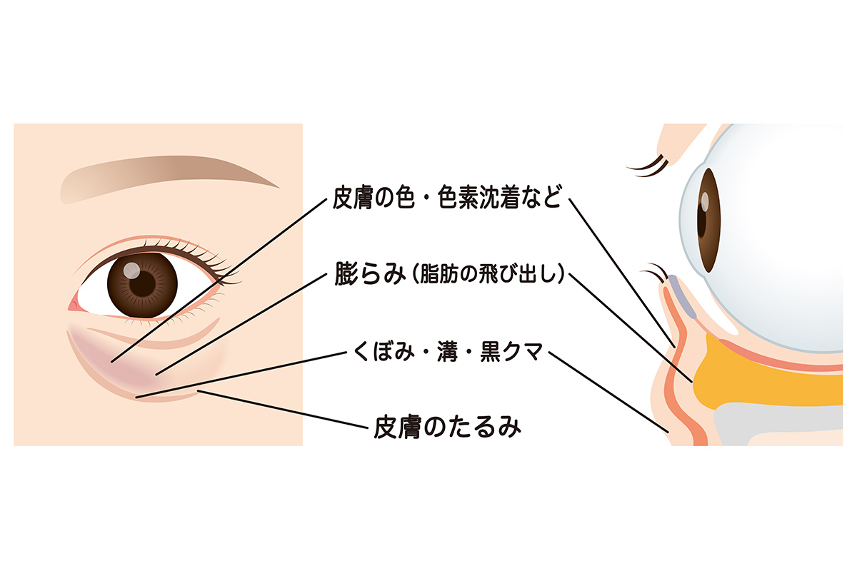 第1章 笑うと目の下が膨らむ主な２つの原因